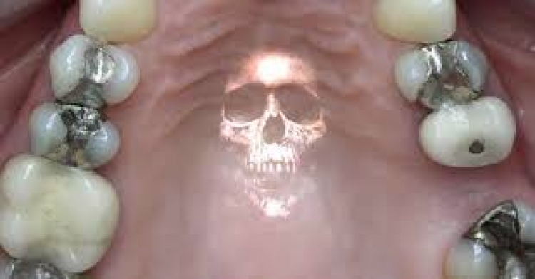 Pak me vonesë, por dhe në Shqipëri dentistët nuk do na mbushin më dhëmbët me amalgam