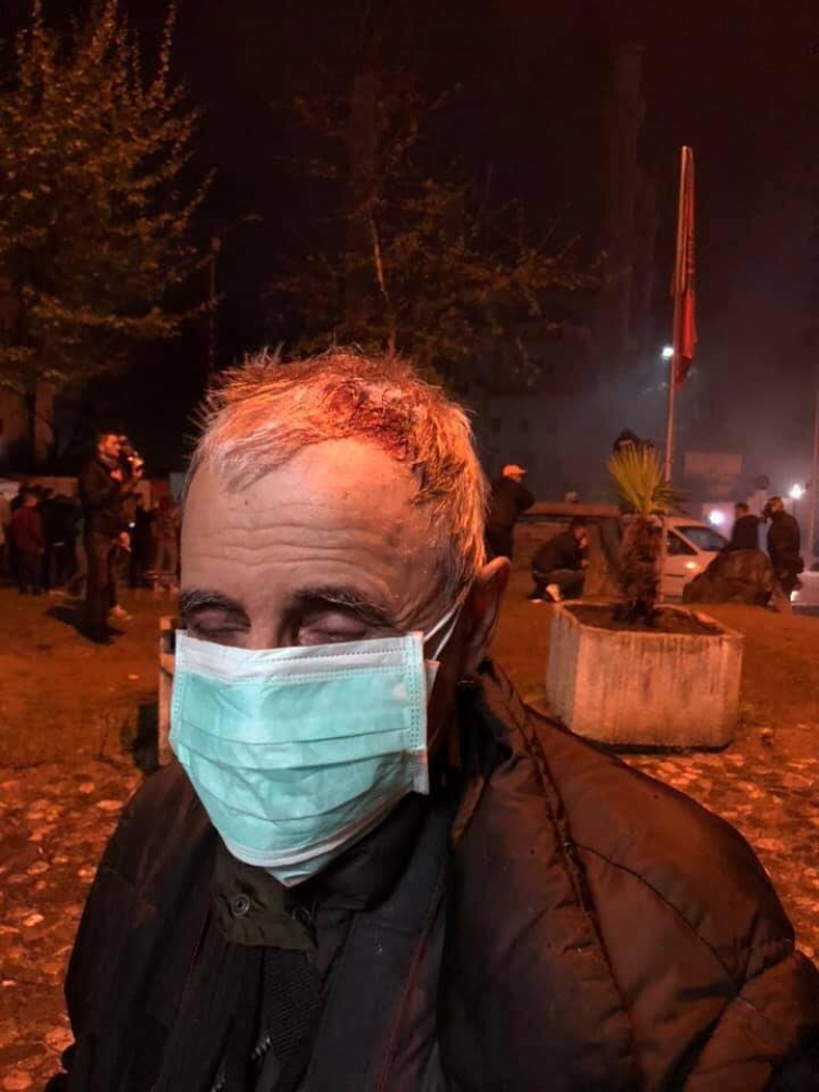 PROTESTA E OPOZITËS/ Situata e tensionuar, fotograf e gazetarë të plagosur [FOTO]