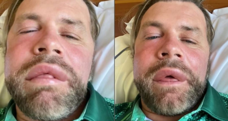 'Botox dhe mbushës falas!/ Ylli i muzikës pëson reaksion alergjik pasi u pickua nga bleta (VIDEO)