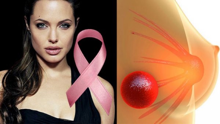 Kanceri i gjirit, këto janë këshillat që doktoresha e Angelina Jolie  këshillon për  të gjitha femrat