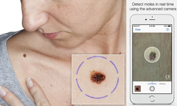 Aplikacioni që skanon lëkurën për të zbuluar kancerin