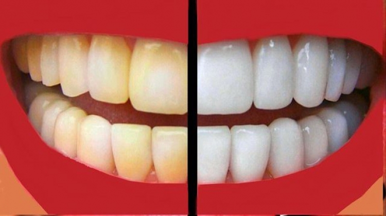 5 rregullat e arta për dhëmbë të bardhë dhe të pastër pa shkuar tek dentisti