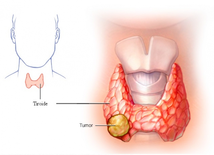 Kanceri i tiroides, trajtimi