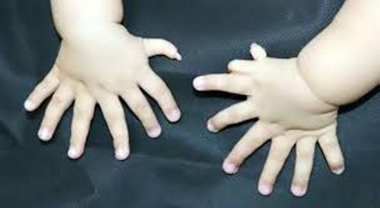 A janë shumë 7 gishta në dorë?  Wow! 31 gishta tek gjymtyrët e një foshnje [FOTO]