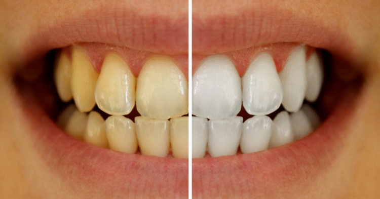 5 mënyra të thjeshta si të shpëtoni prej ngjyrës së verdhë të dhëmbëve!