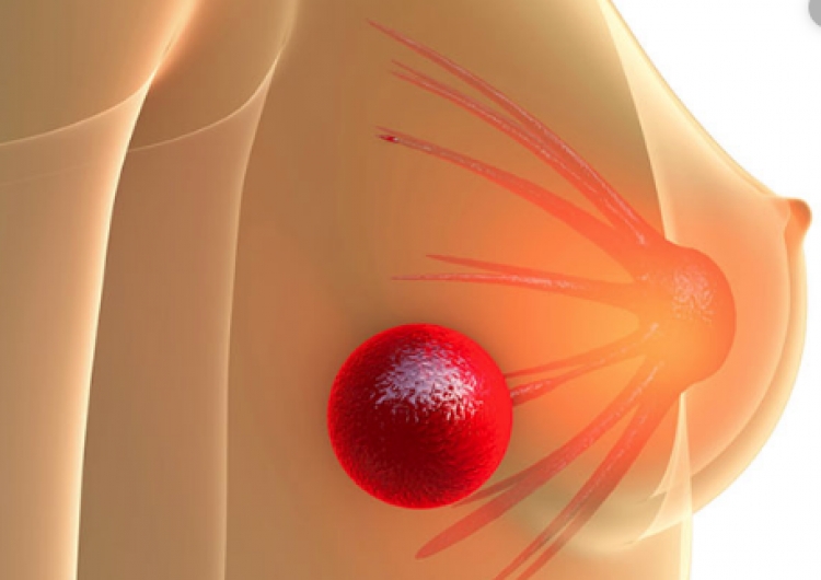 Një hap përpara, zbulohet mënyra sesi mund të vriten qelizat tumorale të gjirit