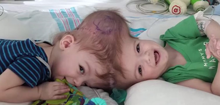 E rrallë: Doktori bën mrekullinë, ndan binjakët dhe u shpëton jetën! [VIDEO]