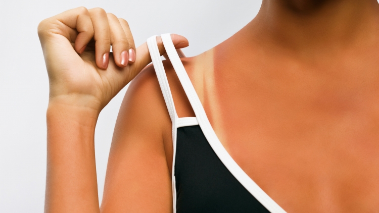 5 trajtime natyrale si të qetësoni djegiet nga dielli në kushte shtëpie
