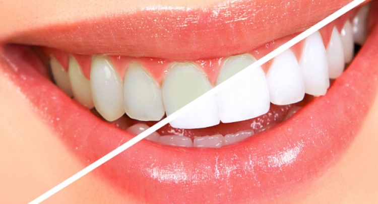 Përtoni të lani dhëmbët? Ja rreziqet që sjell moslarja e tyre