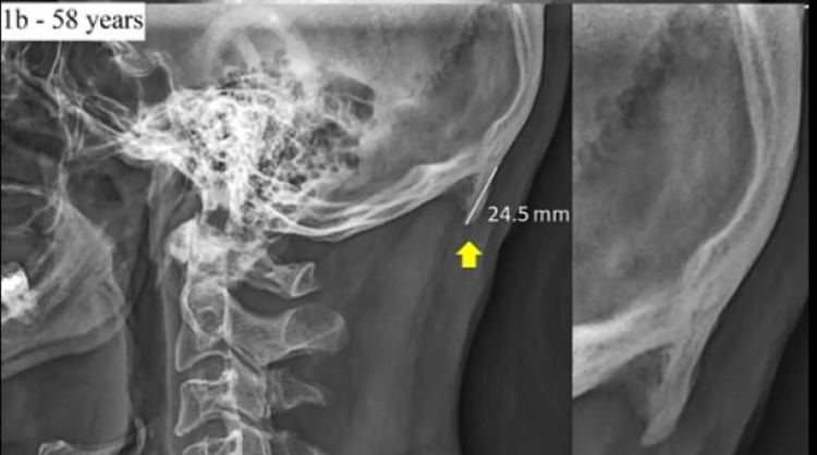 Qëndrimi në telefon po ''shndërron'' skeletin e njerëzve [FOTO]