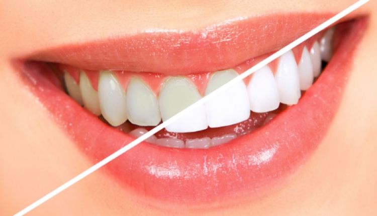 Nëse bëni këtë veprim para se të lani dhëmbët thojini “LAMTUMIRË” dentistit
