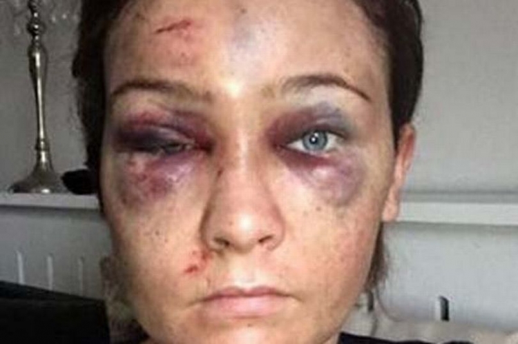 26-vjeçarja dhunohet për gjashtë orë nga ish-i dashuri. E katandisi aq keq sa as vajza e saj nuk e njohu